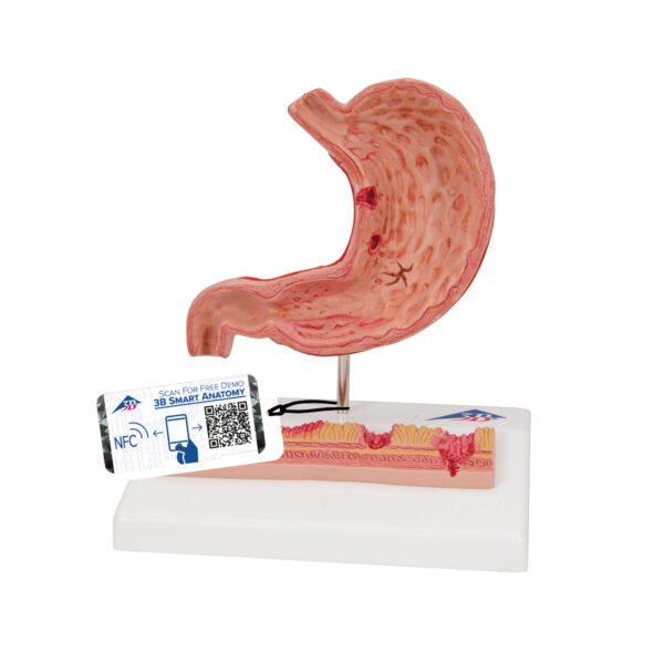 Модель желудка с язвами, 2 части - 3B Smart Anatomy — изображение 2