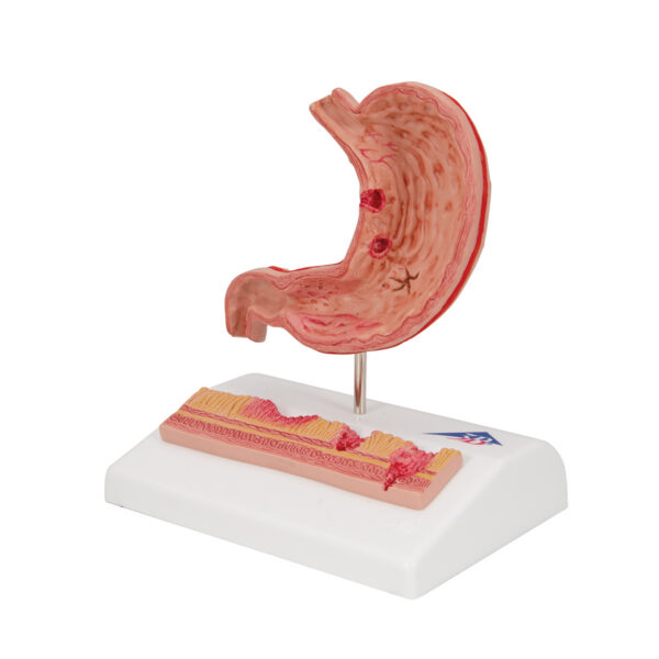 Модель желудка с язвами, 2 части - 3B Smart Anatomy — изображение 7