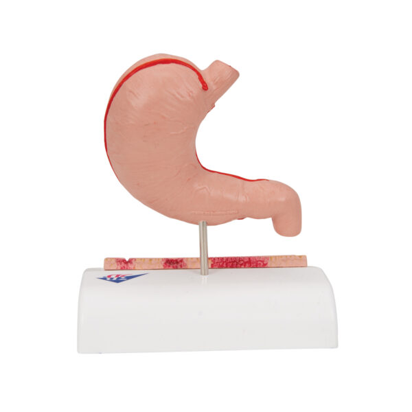Модель желудка с язвами, 2 части - 3B Smart Anatomy — изображение 5