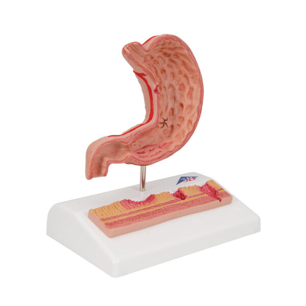 Модель желудка с язвами, 2 части - 3B Smart Anatomy — изображение 3