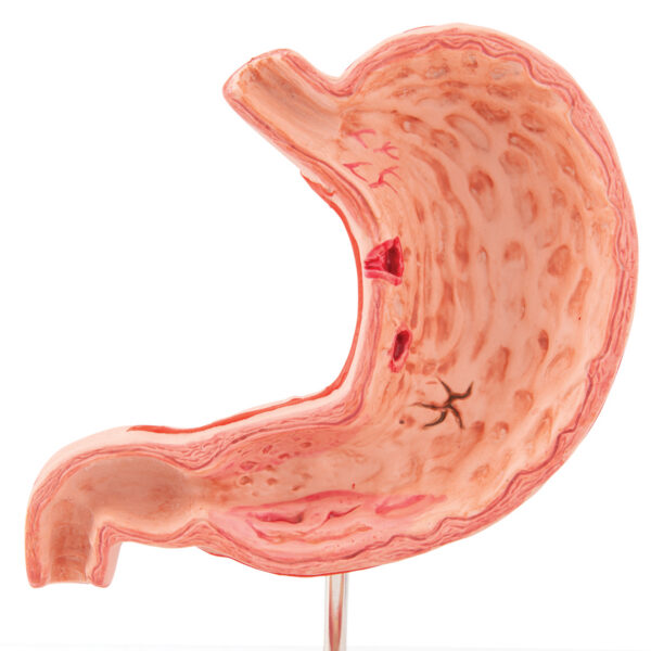 Модель желудка с язвами, 2 части - 3B Smart Anatomy
